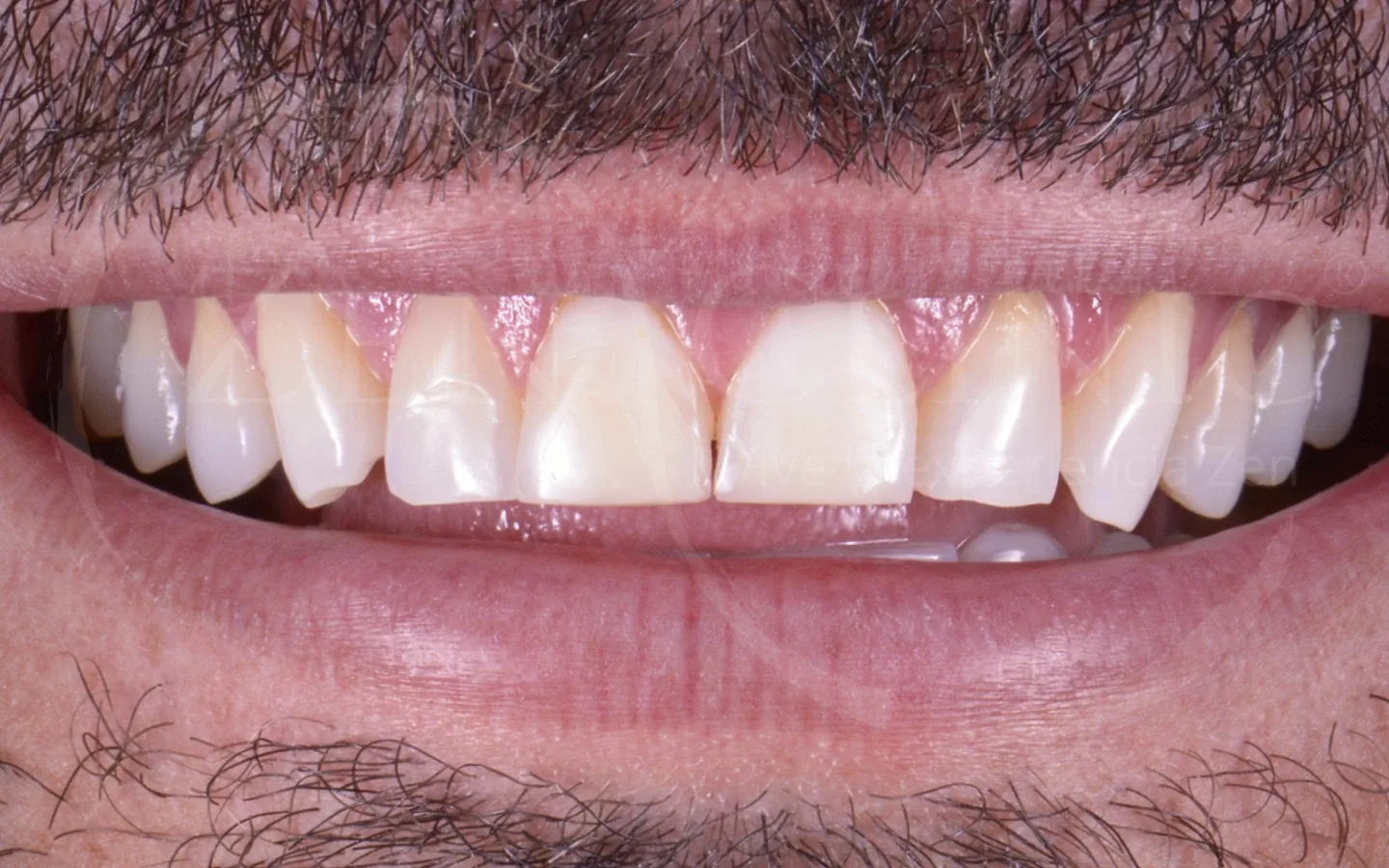 Antes: caso 6, diseño de sonrisa con carillas cerámicas