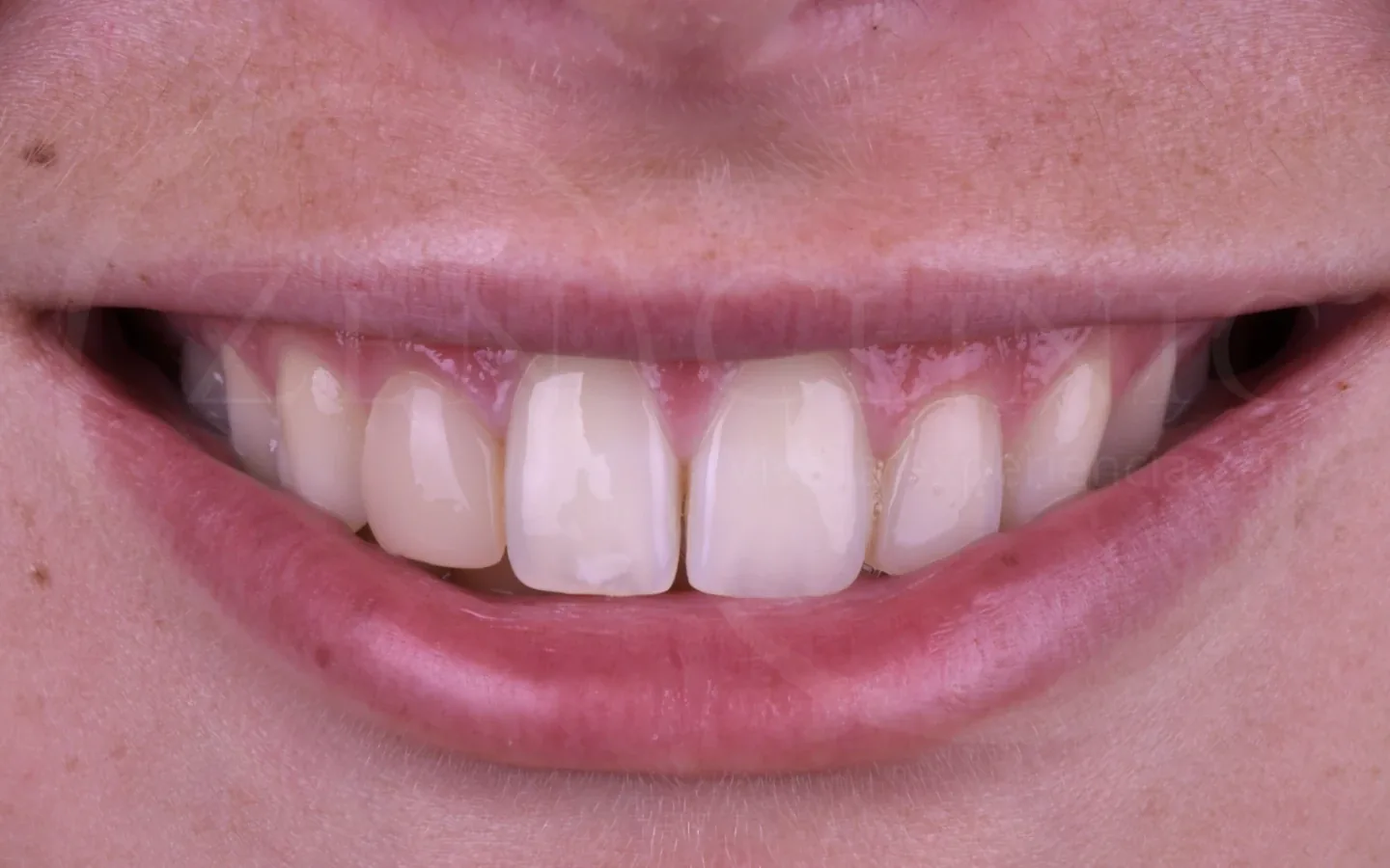 Antes: caso 7, diseño de sonrisa con carillas cerámicas