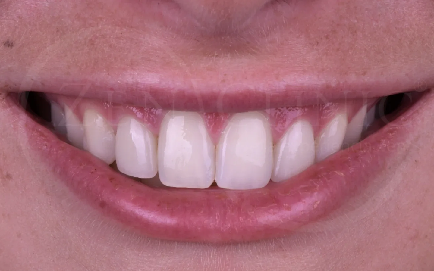 Después: caso 7, diseño de sonrisa con carillas cerámicas