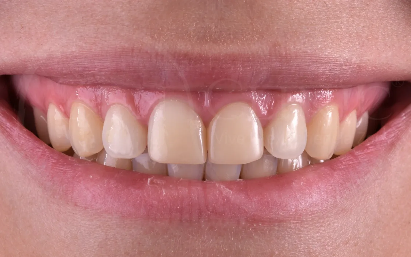Antes: caso 8, diseño de sonrisa con carillas cerámicas