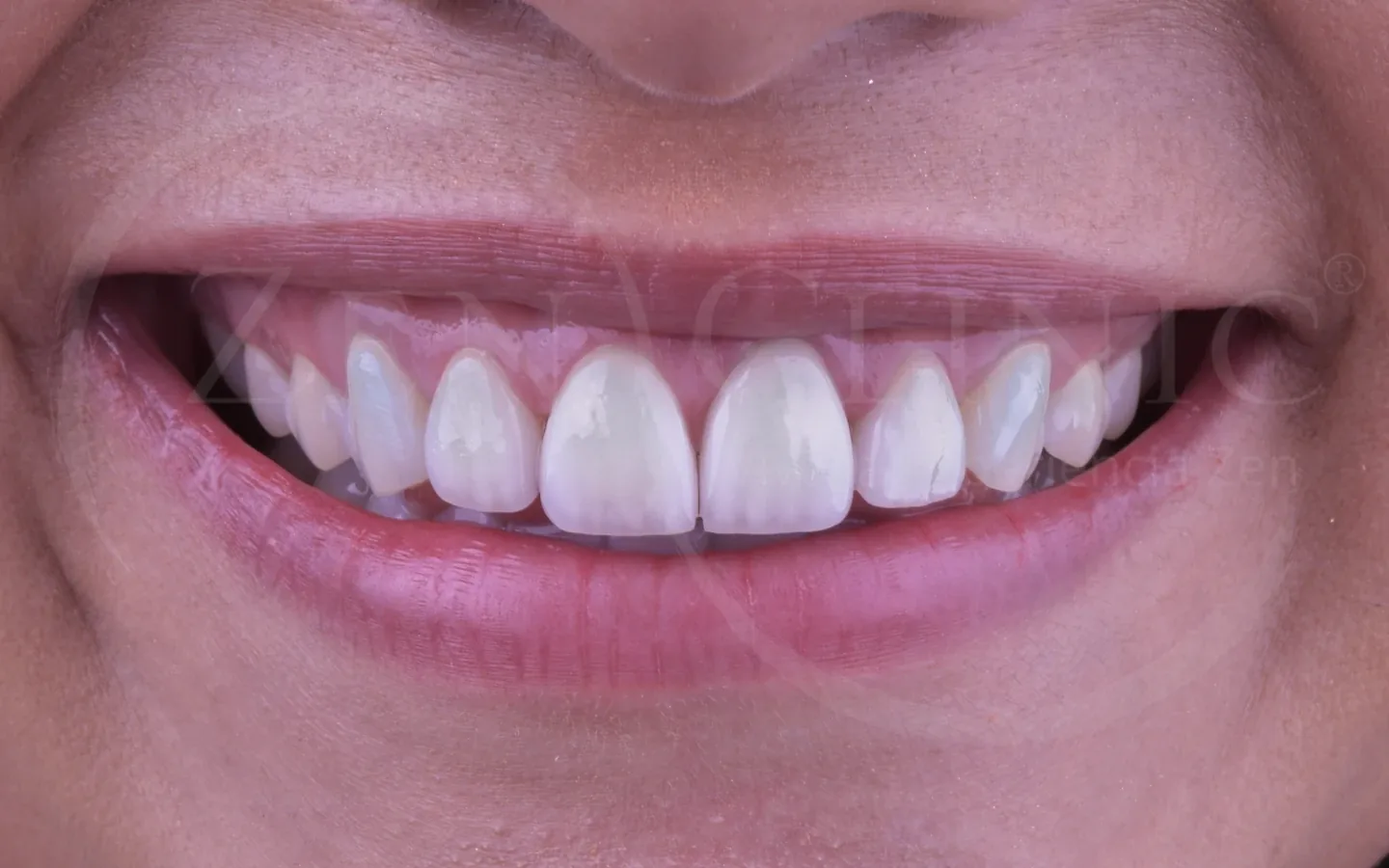 Después: caso 9, diseño de sonrisa con carillas cerámicas